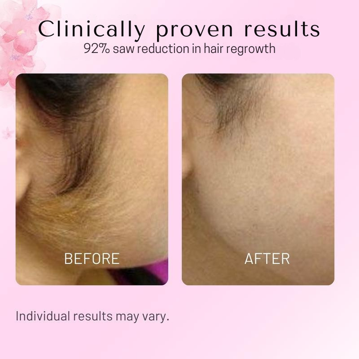 Cyperus Rotundus Oil for Hair Reduction