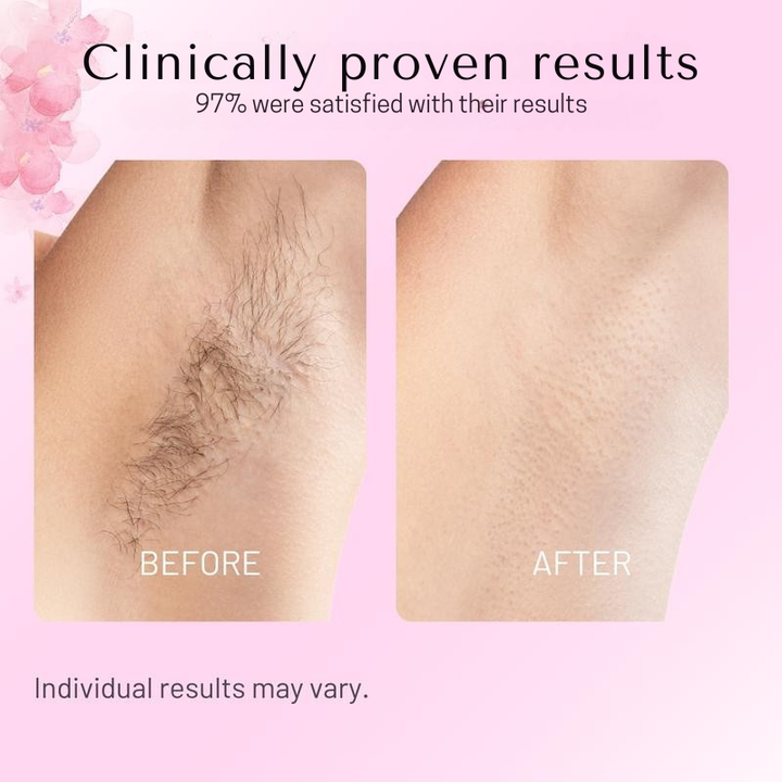 Cyperus Rotundus Oil for Hair Reduction